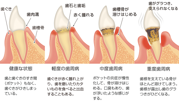 歯周病の進行イメージ図